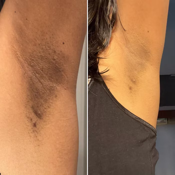 Antes e depois — paciente 4